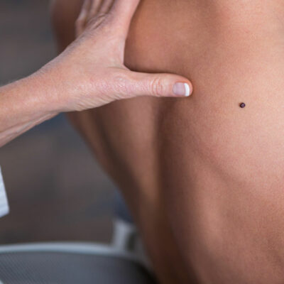 Common Signs and Symptoms of Melanoma