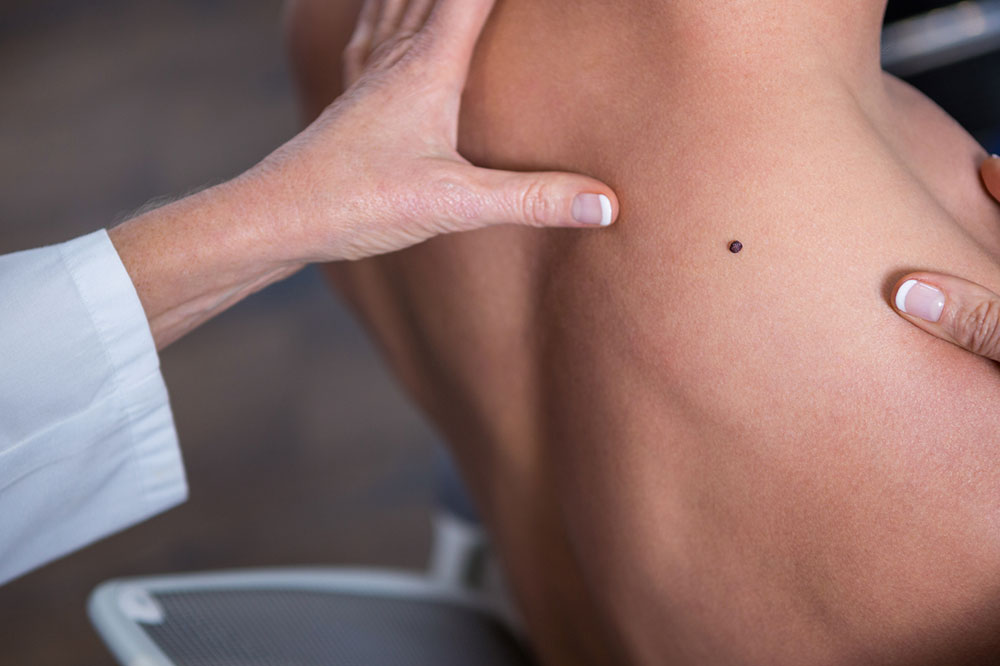 Common Signs and Symptoms of Melanoma