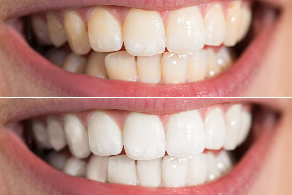 4 Top Natural Ways to Whiten Teeth at Home