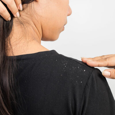 5 Easy Tips for Preventing Dandruff and Flakes