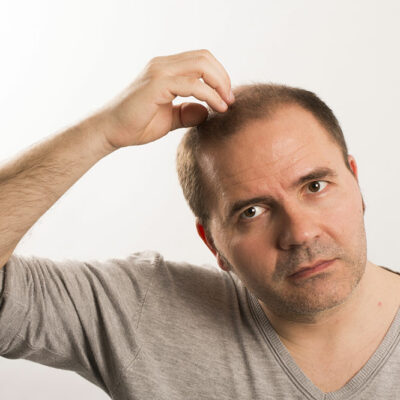 5 Home Remedies to Manage Male Pattern Baldness