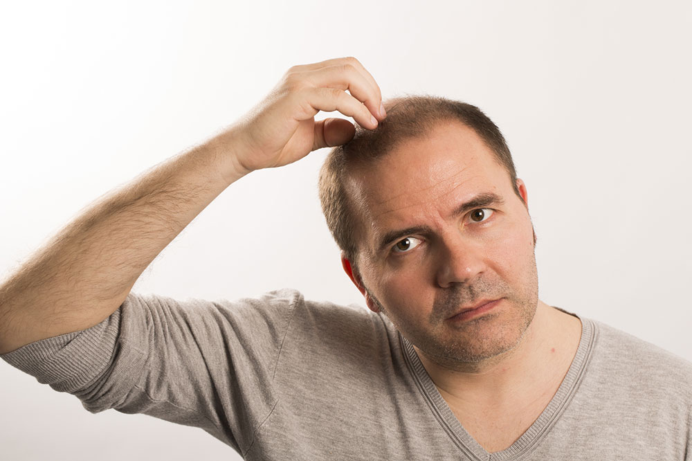 5 Home Remedies to Manage Male Pattern Baldness